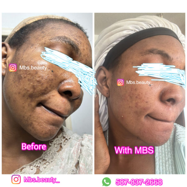 Spots Removal Face Kit - Image 6