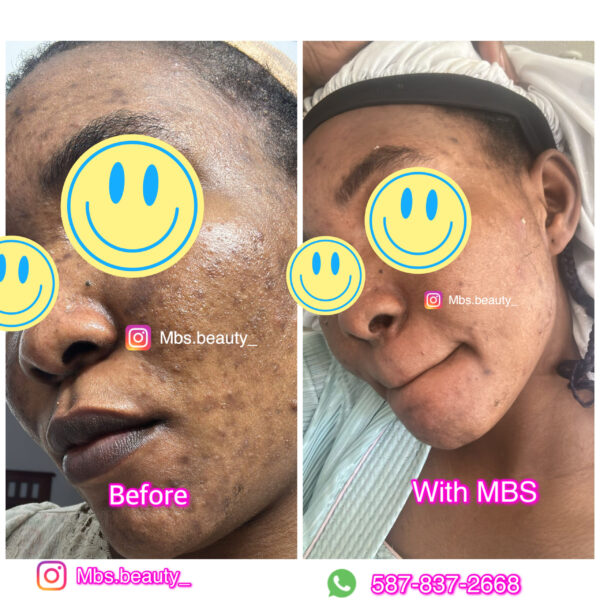 Spots Removal Face Kit - Image 4