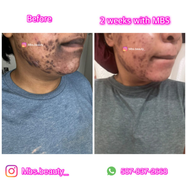 Spots Removal Face Kit - Image 7