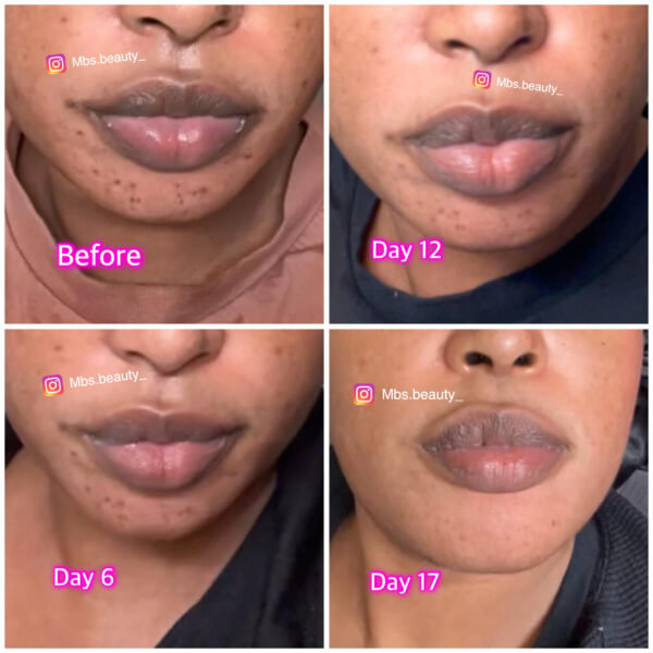 Spots Removal Face Kit - Image 3