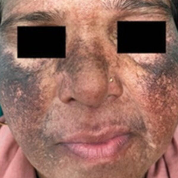 Anti Melasma Treatment Cream - Image 2