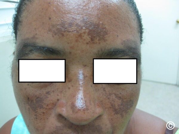 Anti Melasma Treatment Kit - Image 7