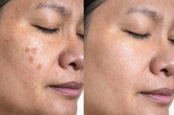 Anti Melasma Treatment Kit - Image 2