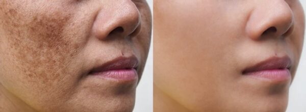 Anti Melasma Treatment Kit - Image 3
