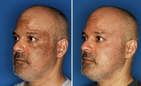 Anti Melasma Treatment Kit - Image 4